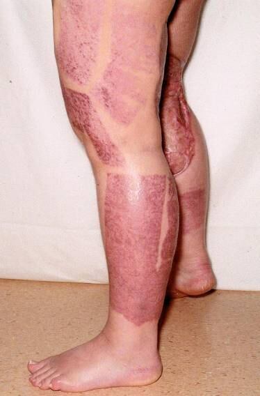 Os médicos fizeram diversas cirurgias para remover a pele
doente e reaplicaram pele retirada de suas costas. Durante a cirurgia, os
médicos descobriram que Dana tinha desenvolvido infecção generalizada e que
poderia entrar em choque séptico. Os rins e o coração chegaram a falhar quatro
vezes. Para aumentar suas chances de sobrevivência, os médicos a colocaram em
coma induzido por nove dias