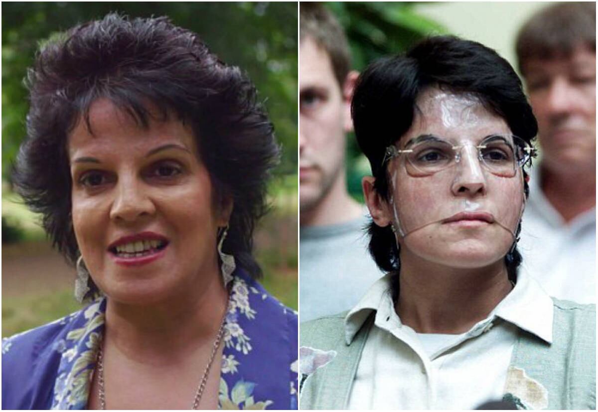 Quando finalmente conseguiu acordar, ela recebeu enxertos de pele e teve que usar uma máscara de plástico durante 23 horas por dia, durante 18 meses, para ajudar seu rosto a se recuperar dos ferimentos


(Com informações do Daily Mail)