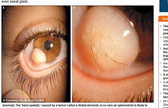 Estima-se que a dermoide limbar atinge duas em cada 10 mil pessoas no mundo