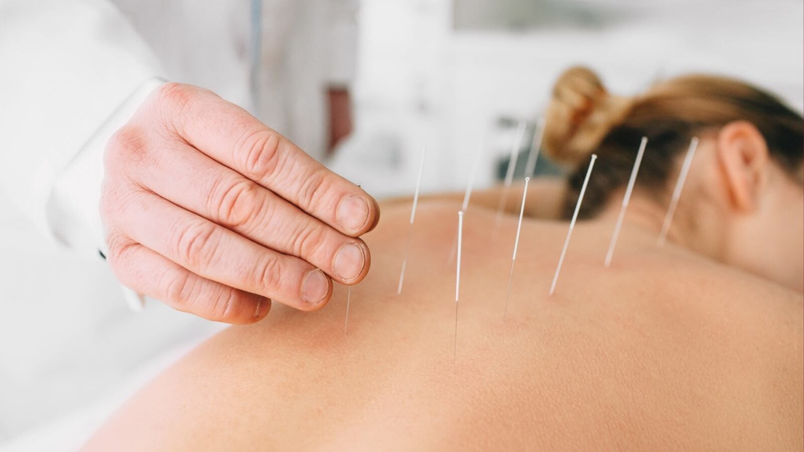 Os benefícios da acupuntura