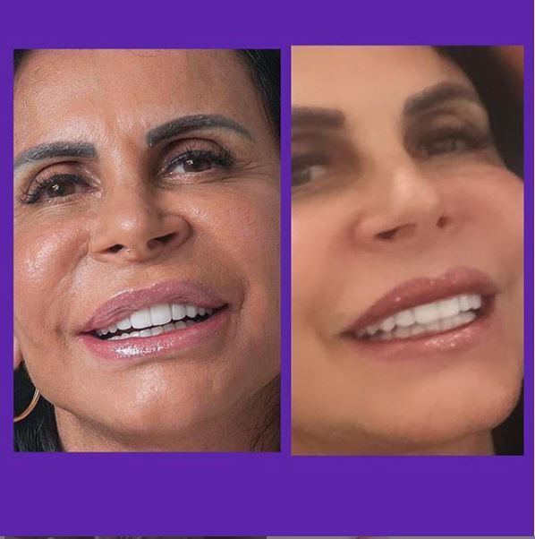 Gretchen-harmonização facial