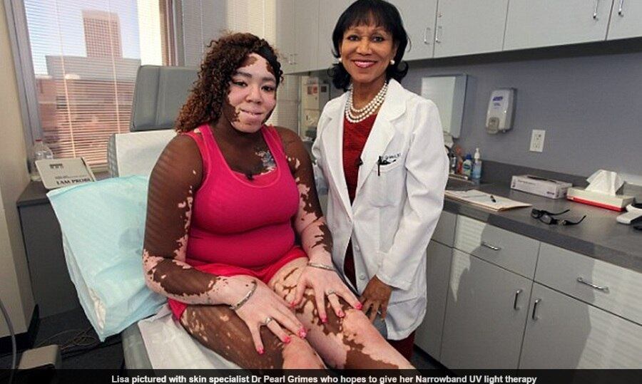 

Lisa sofre de vitiligo desde a infância. À publicação, ela
contou que sempre foi alvo de piadas por causa das manchas brancas espalhadas
pelo seu corpo.

 — Quando estava na escola, as pessoas xingavam e eu só tinha
vontade de ir para casa chorar

