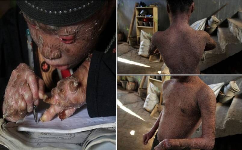 Ari Wibowo, de 16 anos, convive com uma condição muito rara e angustiante. Diagnosticado com erythroderma ― uma doença inflamatória da pele ―  o adolescente troca de pele a casa 41 dias, fazendo com que fosse apelidado de “menino cobra”