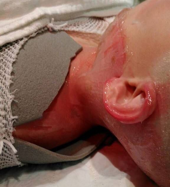 Em julho, o garoto Wesley Smith, de apenas 10 anos, também adquiriu ferimentos severos por conta do desafio
