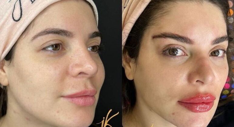 Olhos de raposa
Gkay é conhecida por assumir todos os procedimentos estéticos que faz. Um deles deu o que falar em 2022. Chamada de fox eyes, ou olhos de raposa, a técnica consiste em mudar o formato dos olhos usando fios de PDO (polidioxanona), que são colocados no rosto, abaixo da sobrancelha, e puxados em direção ao couro cabeludo
