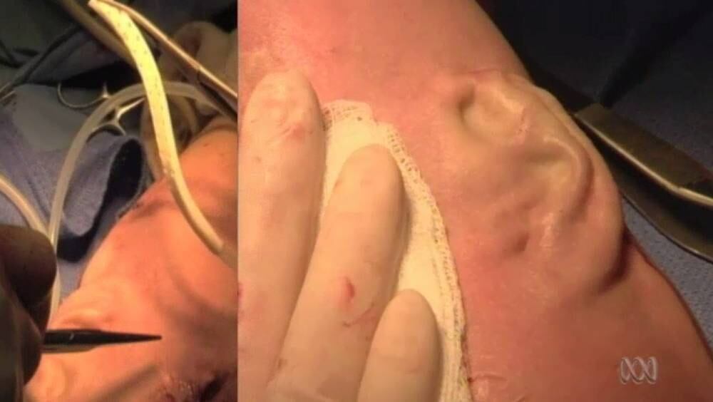 Em 1996 o australiano já tinha o sonho bizarro de possuir uma terceira orelha no braço, mas só conseguiu realizar a operação dez anos depois