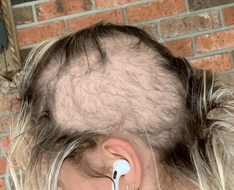 As falhas começaram a aparecer aos 12 anos. Na época, a avó atribuiu a queda dos fios ao fato de Chloe sempre usar o penteado rabo de cavalo muito apertado