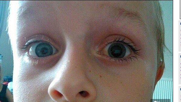 Lawrence e seus irmãos estavam fazendo pulseiras com o
material conhecido por “RainbowLoom” quando uma delas estourou e acertou o olho
do menino. De acordo com Carlie, mãe dos meninos, seu filho soltou um grito e
ela saiu correndo para checar o que estava acontecendo. 


― Ele começou a gritar muito e reclamar de muita dor. Fiquei
tão chocada que não conseguia fazer nada, meu marido que teve que acudi-lo 