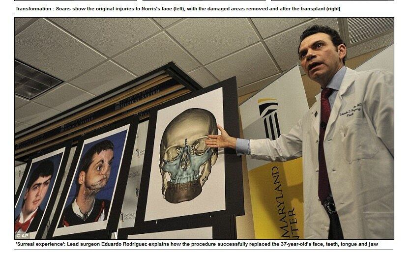 A reconstrução facial foi liderada pelo cirurgião plástico Dr. Eduardo D. Rodriguez, da Universidade de Maryland