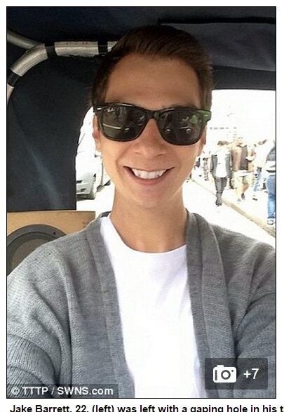 O assistente de vendas Jake Barrett sofreu uma reação rara a
uma das substâncias químicas do produto, o que provocou a abertura de um buraco
embaixo de sua língua