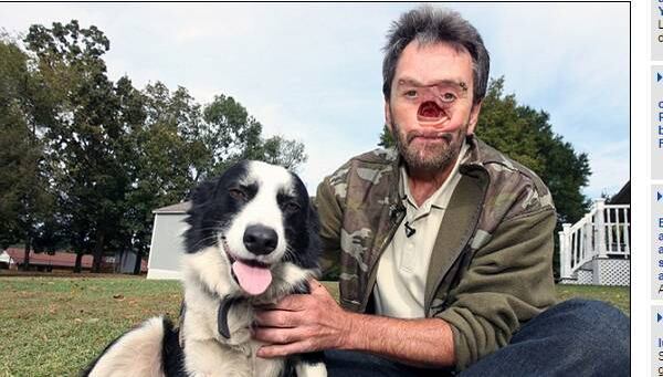 Após
passar quase dez anos com vergonha de sair de casa, Fritts se submeteu a duas reconstruções de
face que deram de volta sua confiança

Chinesa tem tumor em metade de seu corpo; veja as fotos
