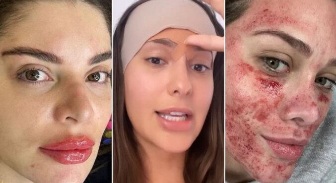 As celebridades fizeram inúmeros procedimentos estéticos durante 2022, desde aqueles mais conhecidos, como a já clássica harmonização facial, até outras técnicas que chamaram atenção por serem bem inusitadas. Elas também viraram notícia por exibirem cada passo dos tratamentos, com fotos de antes, durante e depois. Confira a seguir alguns dos procedimentos 'diferentões' dos famosos que marcaram o ano