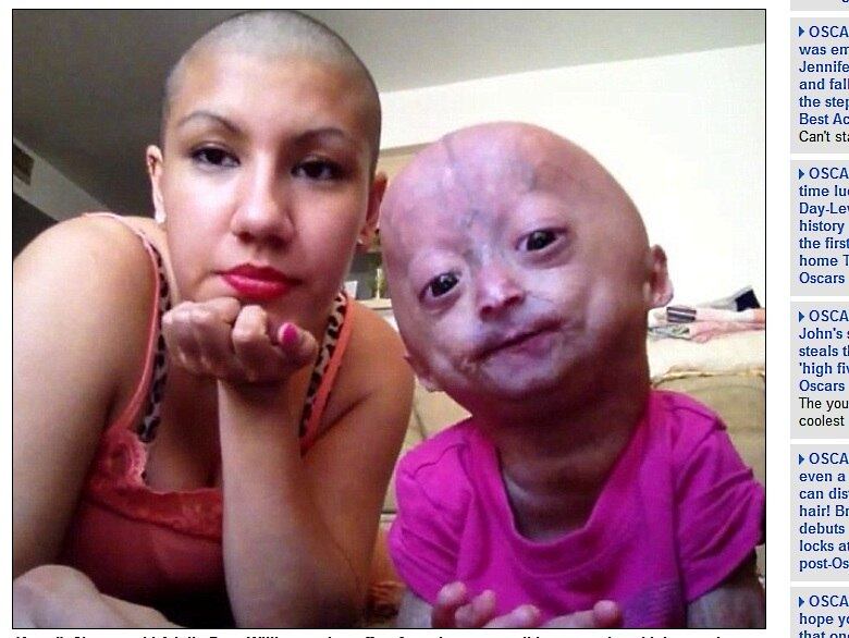 

Com seis milhões de fãs no Facebook,
Adalia Rose, de seis anos, surgiu aos olhos do público devido a uma condição
rara de envelhecimento precoce