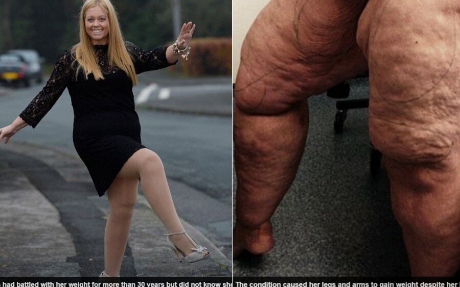 Faye Rodgers-Harris, de 40 anos, passou por uma lipoaspiração para retirar 12 litros de gordura de suas pernas. Após a operação, ela reduzir os 91 cm de pernas e ficar com um tamanho “normal”. Leia a história completa!