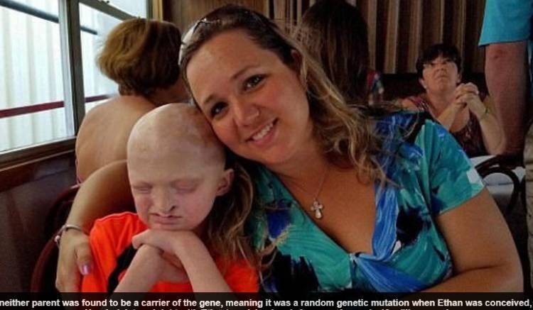 O
menino Ethan Kranig, de Prescott, Wisconsin (EUA), de nove anos, não pode
chorar ou suar e só tem dois dedos em cada mão devido a uma doença rara causada
por uma mutação genética que afeta apenas uma em cada 10 milhões de pessoas.
Apesar das limitações provocadas pela doença, o menino tenta viver uma vida
normal