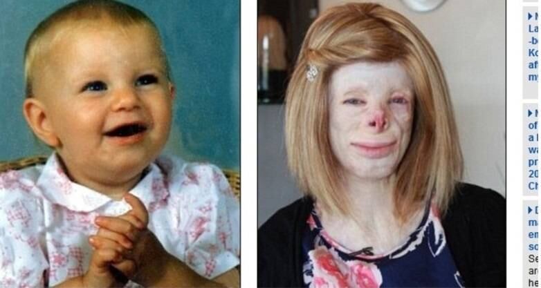 Aos 16 anos, a adolescente Terri Calvesbert tenta levar uma vida como a de qualquer outra garota da sua idade. Após ter 90% do corpo queimado quando era criança, Terri está voltando à vida social aos poucos. Com apenas dois anos de idade, Terri quase morreu após um incêndio provocado acidentalmente por sua mãe que deixou um cigarro aceso em seu quarto. Ela perdeu cabelo, nariz e pálpebras. Terri já passou por mais de 50 cirurgias, mas vai precisar de enxertos de pele para o resto da vida. Para esconder a careca, a adolescente usa uma peruca loira. Leia mais sobre a história de Terri