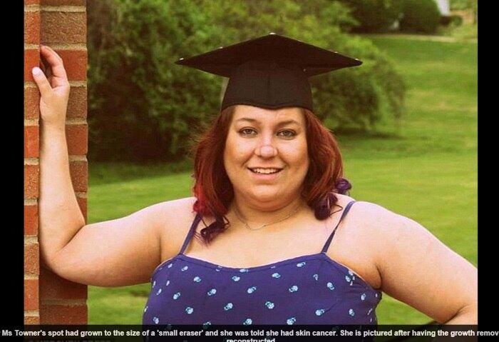 Os médicos tiveram que raspar o nariz da mulher mais de
quatro vezes, para retirar toda a pele afetada pelo câncer