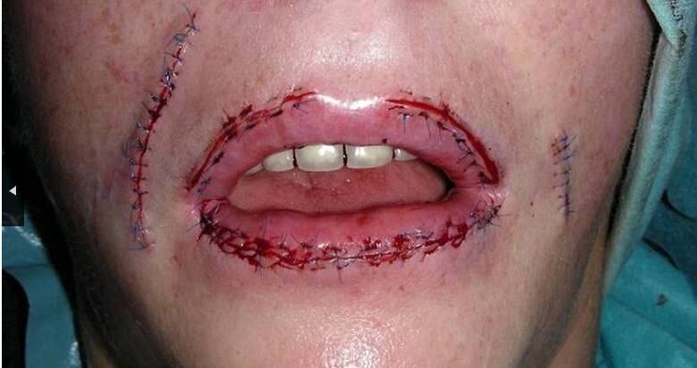 A britânica Stacey Hohn,
de 41 anos de idade, ficou com o rosto deformado após uma cirurgia de
preenchimento dos lábios. O material aplicado provocou inflamação