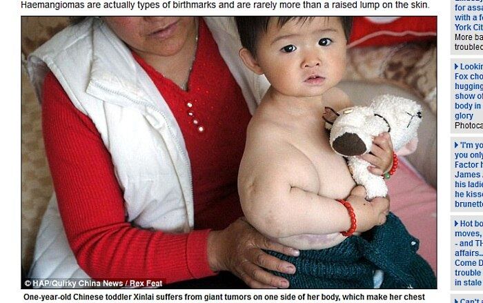 A pequena Xinlei, de apenas um ano, está se esforçando para aprender a andar devido a tumores gigantes que cresceram do lado direito do seu corpo, fazendo o peito e o braço incharem