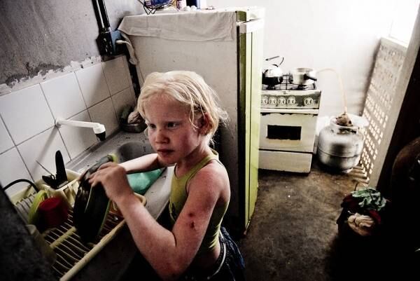 No ensaio À Flor da Pele, Severo retrata uma família em que irmãos nasceram muito diferentes: 

"O mais novo diz que é branco vira-lata. Os insultos do colégio viraram identidade. A mãe cochicha que são anjinhos. Eles têm raça sim. São filhos de mãe negra. O pai é moreno. Estiraram língua para as estatísticas e, por um defeito genético, nasceram albinos. Negros de pele branca"