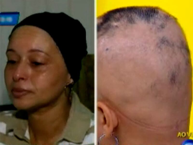 Ela contou que foi clarear as pontas do cabelo, mas a
cabeleireira acabou pintando todo o cabelo. Após a aplicação do produto, o
couro cabeludo começou a queimar e ferir. Alguns dias depois, o cabelo começou
a quebrar e cair. Assista ao vídeo