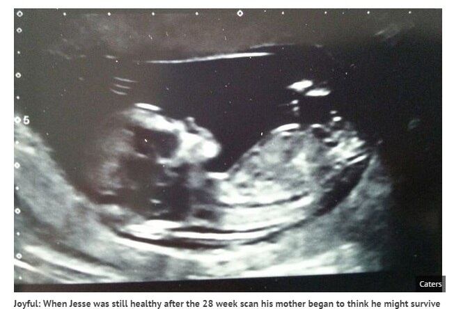 Nicola
lembra o quanto foi duro ouvir dos médicos que talvez não conseguisse completar
a gestação de seu bebê.



— Partiu
meu coração. O que eu mais queria na vida era ser mãe. Sem a costura Jesse
jamais teria conseguido. Fiquei com medo, porque era uma alternativa que envolvia riscos, como, por exemplo, o
de sofrer um aborto. Mas, assim que eu soube que tinha dado tudo certo e que
Jesse havia sobrevivido, senti como se tivesse havido um milagre