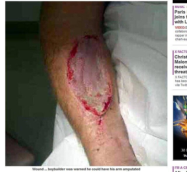 Gary Meadows, de 33 anos, quase perdeu o braço depois de ser
picado por uma aranha venenosa do tamanho de uma ervilha. O rapaz estava
trabalhando em uma plantação quando o aracnídeo afundou suas presas em seu
braço
