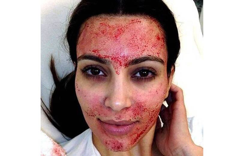 A socialite Kim Kardashian também pegou pesado! A moça chocou ao postar uma foto em que aparecia com o rosto coberto de sangue, enquanto fazia um tratamento estético

+ Veja dez momentos em que Roberto Justus "lacrou" com seu bom humor nas redes sociais
+ Conheça as celebridades que não perdem a chance de se envolver em uma boa polêmica
+ Compadre Washington abre o jogo e esclarece briga com Scheila Carvalho: “Fiquei com raiva dela”


