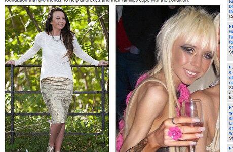 Também em 2012, Emma O’Neil, de 22 anos, de Glasgow, na Inglaterra, sofre com a anorexia. Pesando apenas 20 kg, a garota passou boa parte da adolescência dentro do hospital. Muitas vezes, quando estava deitada na cama, ficava com hematomas pelo corpo. Conheça a história da adolescente