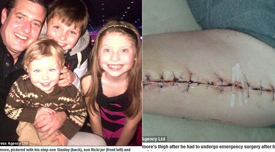 Veneno causou grande inchaço na coxa de Whitimore