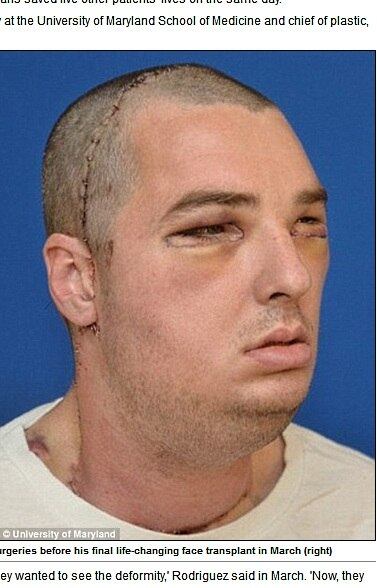 Richard recebeu a nova face de um doador anônimo e uma nova língua para voltar a falar adequadamente, comer, mastigar e poder voltar a sorrir