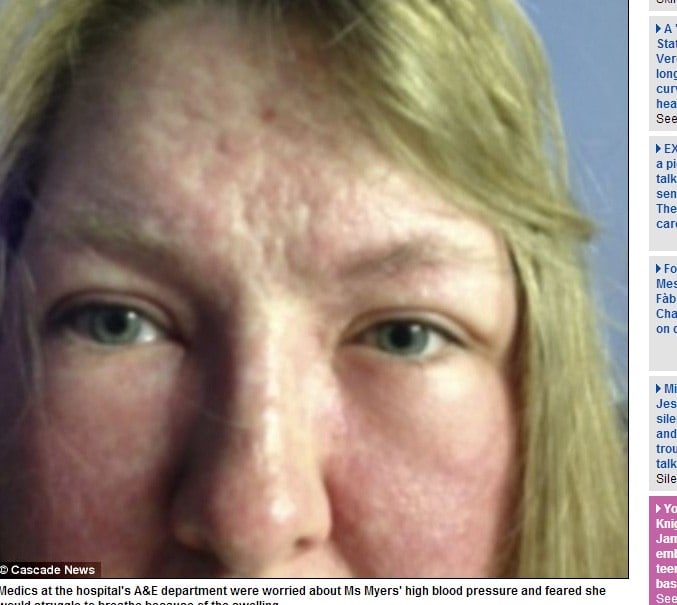 Segundo a dermatologista Ian White, dois dos ingredientes do creme poderiam ser a razão para as reações graves.

Já a fabricante do produto informou que o protetor solar “é seguro e eficaz. Ele contém apenas ingredientes permitidos e é rotulado de acordo com as exigências legais”

