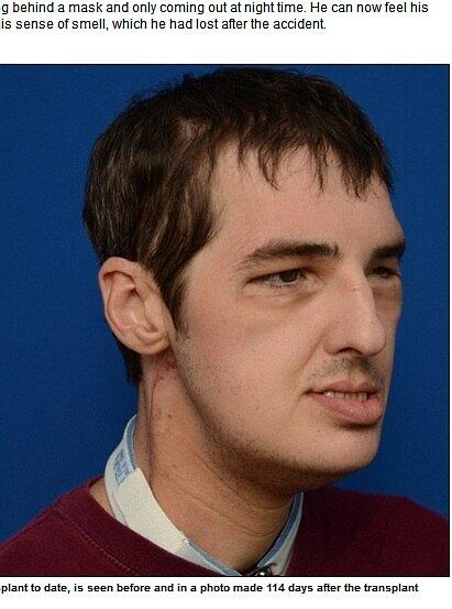 Após várias cirurgias, Richard recuperou 80% da função motora do lado direito do rosto e 40% do lado esquerdo