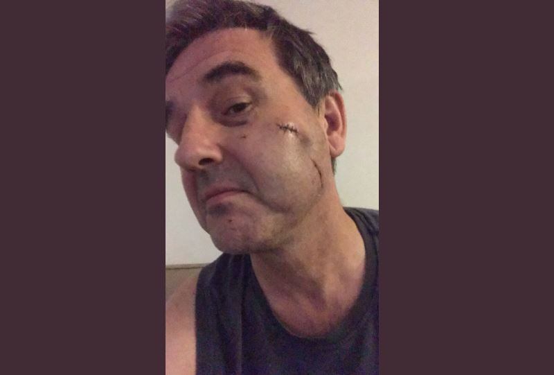 Payne compartilhou fotos do rosto machucado