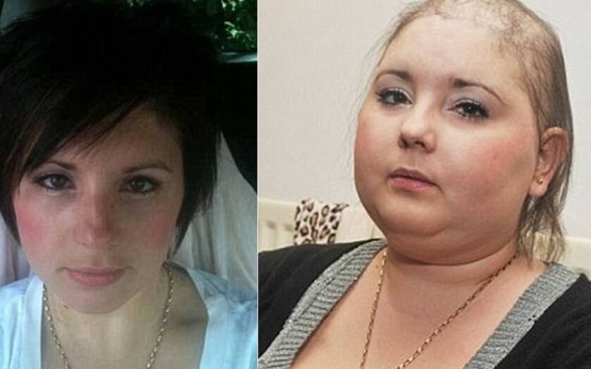 Após vencer a batalha contra a leucemia, a britânica Samantha
Verde, 29 anos de idade, conta sua alegria de ter conseguido um implante capilar gratuitamente. A informação é do site Daily Mail