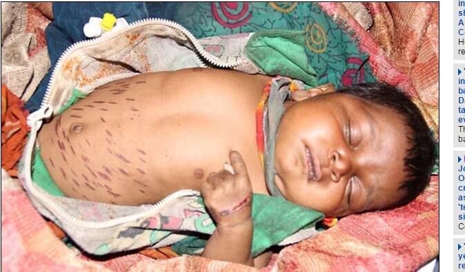 Shivani Seheryiya, de dois meses, foi marcada 40 vezes com uma faca quente por um curandeiro de Sheopur, na Índia, que afirmava que o “procedimento” iria curar uma pneumonia que a criança havia contraído. Apesar de o ritual ser uma prática tradicional do país, Shivani acabou piorando e teve que ser levada às pressas para ao hospital