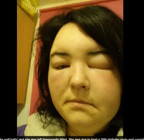 

Ann conta que passou o produto e, quando foi dormir, não
conseguia se deitar porque o coro cabeludo estava muito irritado.



— O travesseiro ficou azul e minha cabeça coçava demais. Foi
tudo muito estranho. Eu não entendi o que estava acontecendo

