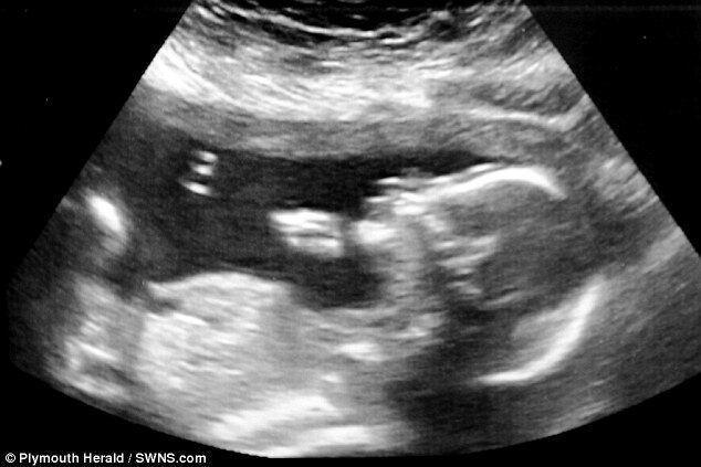 Cirurgiões operaram enquanto sua mãe estava na 24ª semana de gravidez. Até então, essa cirurgia nunca tinha sido feita no Reino Unido