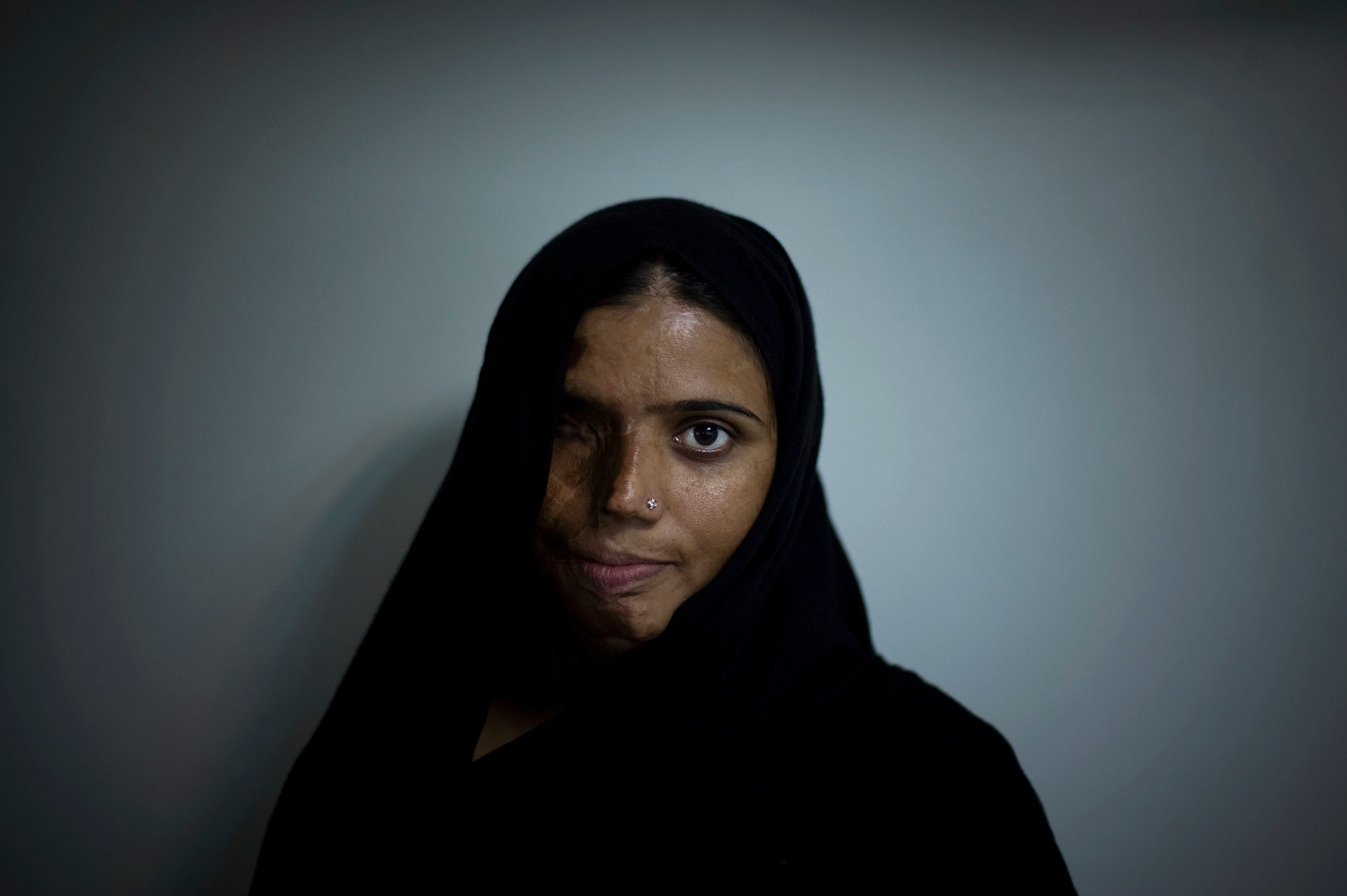 Munira Asef tem 23 anos e o mesmo destino de centenas de mulheres paquistanesas: foi queimada com ácido após recusar um pedido de casamento cinco anos atrás