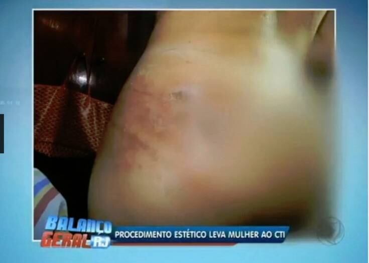 Na busca pela beleza, a jovem brasileira Vânia Prisco, de 29 anos, também sofreu as consequências de aplicar um produto não recomendado pelos médicos para aumentar o bumbum. Após injetar acrílico (substância chamada de PMMA ou metacril), ela teve reações alérgicas e passou por quase 40 cirurgias