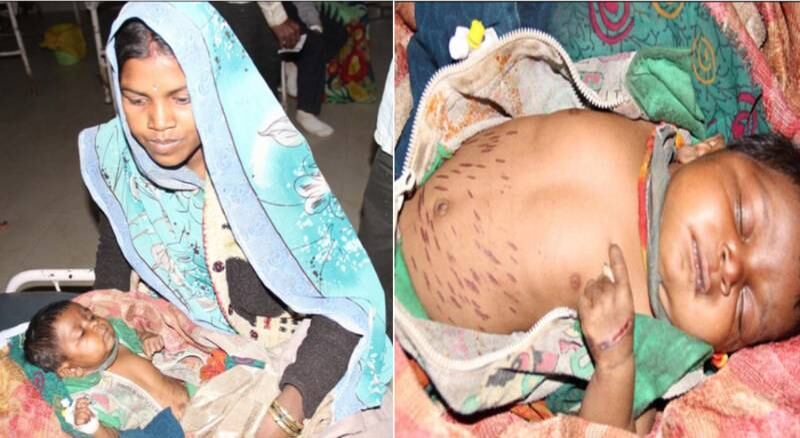 Shivani
Seheryiya, de dois meses, foi marcada 40 vezes com uma faca quente por um
curandeiro de Sheopur, na Índia, que afirmava que o “procedimento” iria curar
uma pneumonia que a criança havia contraído. Apesar de o ritual ser uma prática
tradicional do país, Shivani acabou piorando e teve que ser levada às pressas
para ao hospital. As informações são do site DailyMail