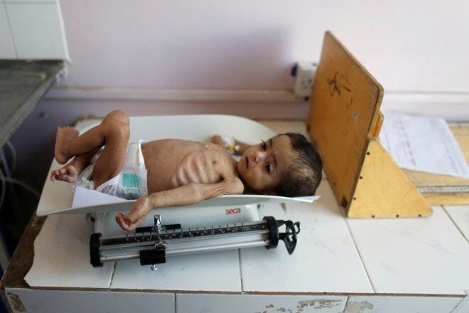 Criança com desnutrição grave no Iêmen, que enfrenta guerra há 4 anos