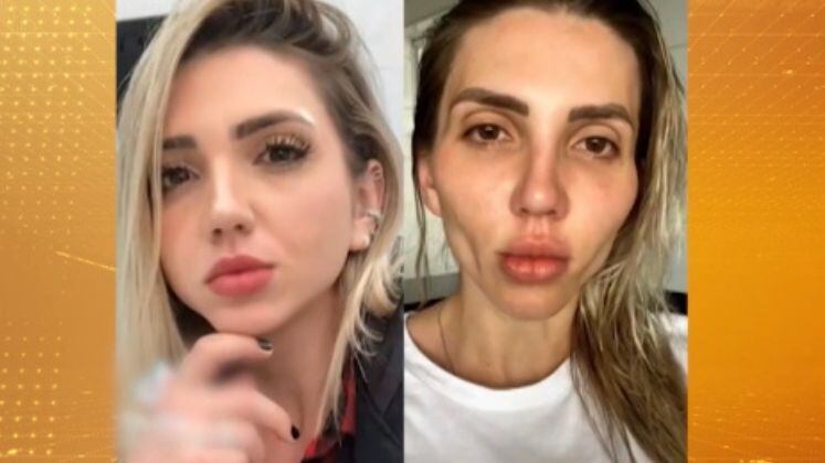 A influenciadora digital Jéssica Frozza revela que teve o sonho transformado em pesadelo. Jéssica conta que o rosto dela não é o mesmo desde a cirurgia. A mulher usou as redes sociais para alertar pessoas que pretendem fazer o procedimento da bichectomia 