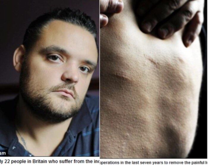 

O britânico Carl Hallan, de 31 anos, sofre com uma doença rara chamada Dercum, que
deixa seu corpo coberto por centenas de pequenas esferas. A informação é do
Daily Mail

Uma doença rara provoca bolas de gordura embaixo da pele de


Síndrome rara faz com que menina meiga viva como um animal na jaula
