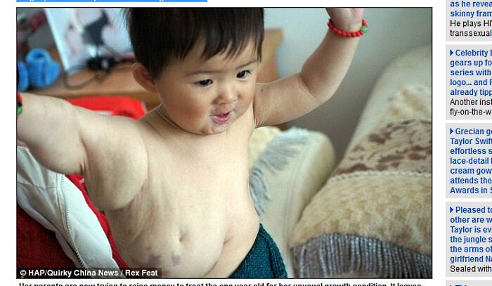 A menina, que mora em Mingxian County, na China, foi diagnosticada com hemangioma congênito – crescimento anormal dos vasos sanguíneos, segundo o site Daily Mail