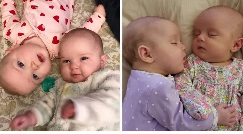 Mesmo com a gravidade da doença, os médicos afirmaram que a bebê está apenas um mês atrasada em relação ao desenvolvimento da irmã