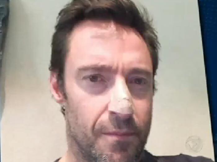 O
ator divulgou uma foto na internet anunciando que descobriu que tinha um
carcinoma basocelular e alertou: "Não sejam tolos como eu! Usem filtro
solar"