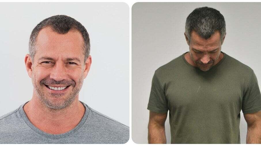 Personalidades que transformaram suas vidas com o transplante capilar