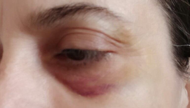 Professora agredida ficou com hematoma no rosto