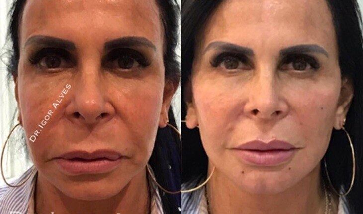 Harmonização facial: confira o 